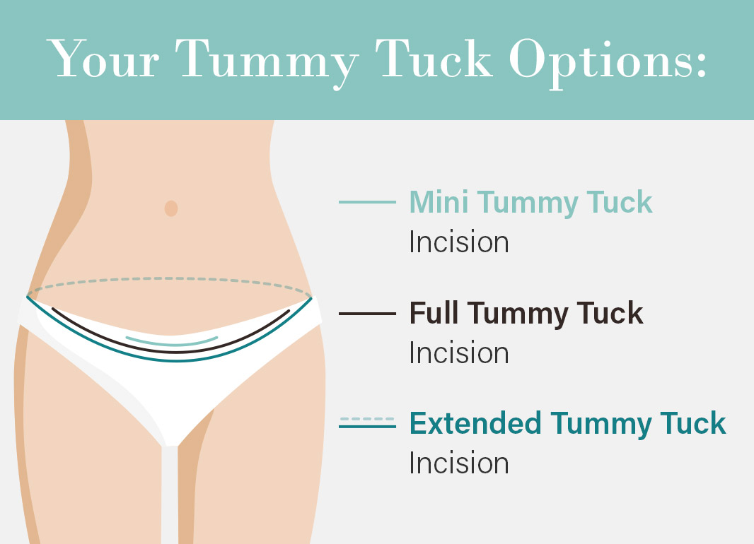 Illustrated abdomen with mini tummy tuck incision shown as short, green above pubic bone, full tummy tuck incision as a black line from hip to hip, and extended tummy tuck incision as green line all the way around the abdomen