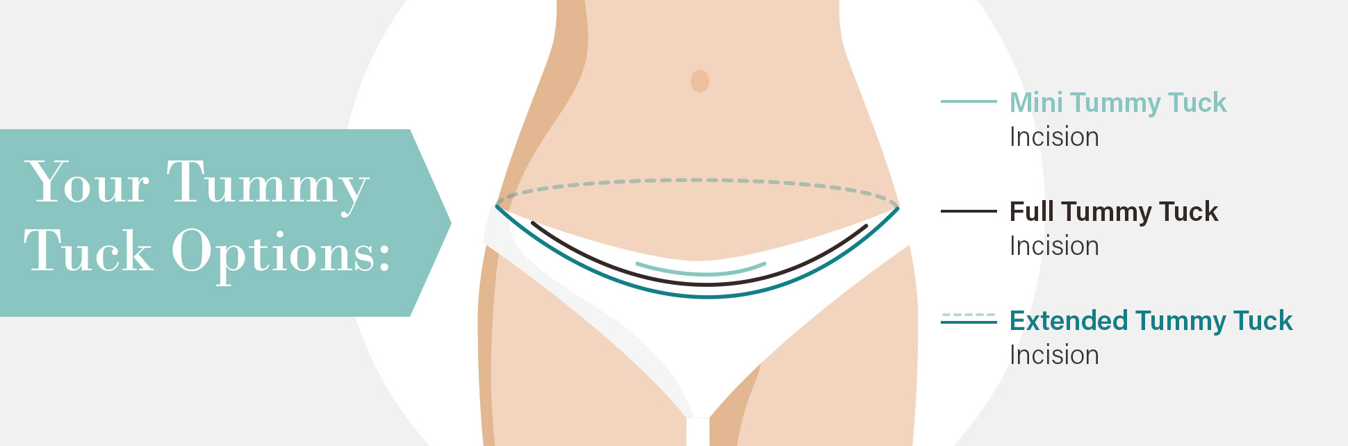 Illustrated abdomen with mini tummy tuck incision shown as short, green above pubic bone, full tummy tuck incision as a black line from hip to hip, and extended tummy tuck incision as green line all the way around the abdomen