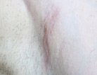 Smaller, flatter, lighter scar after biocorneum