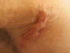 Severe scar before biocorneum