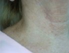 Barely noticeable scar on woman\'s neck