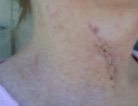 Large, noticeable scar on woman\'s neck