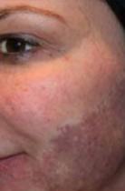 Woman\'s cheek with purple coloring before