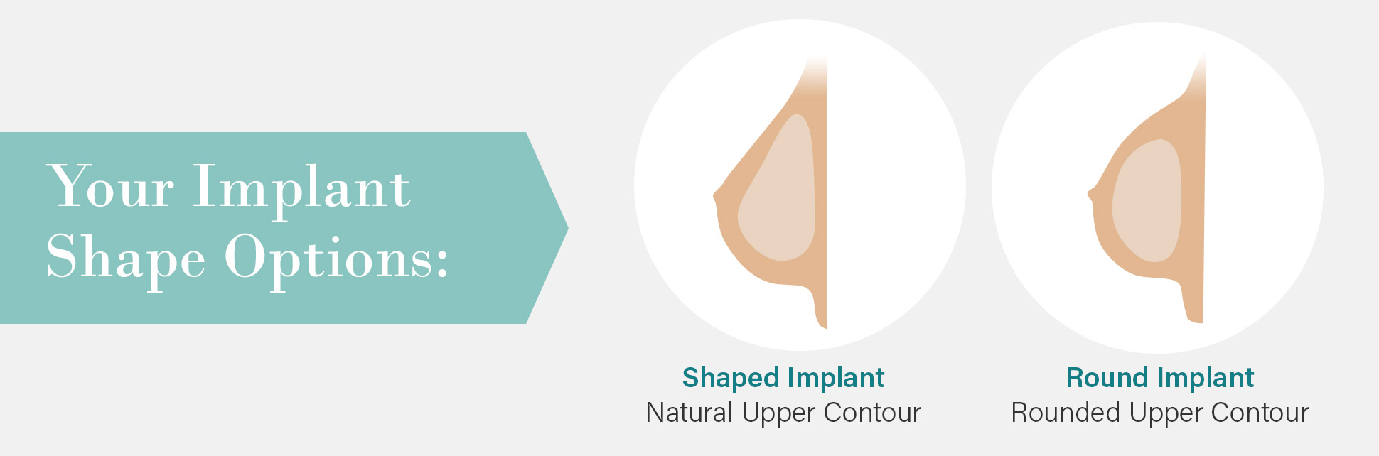 Breast implants can be shaped for a natural upper breast contour or round for a fuller upper breast contour