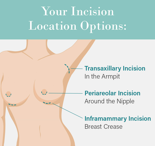 Breast augmentation incisions shown as dashed line in the armpit, around the lower edge of the nipple, and along the breast crease
