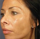 Side of woman\'s face with clear skin after Vi Peel