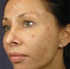 Side of woman\'s face with noticeable acne blemishes