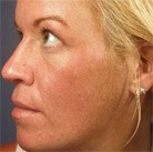 Woman\'s clear, radiant skin after Vi Peel