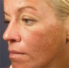 Woman\'s discolored cheek before Vi Peel